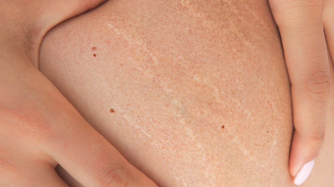 stretch marks,what to know and how to get rid of them