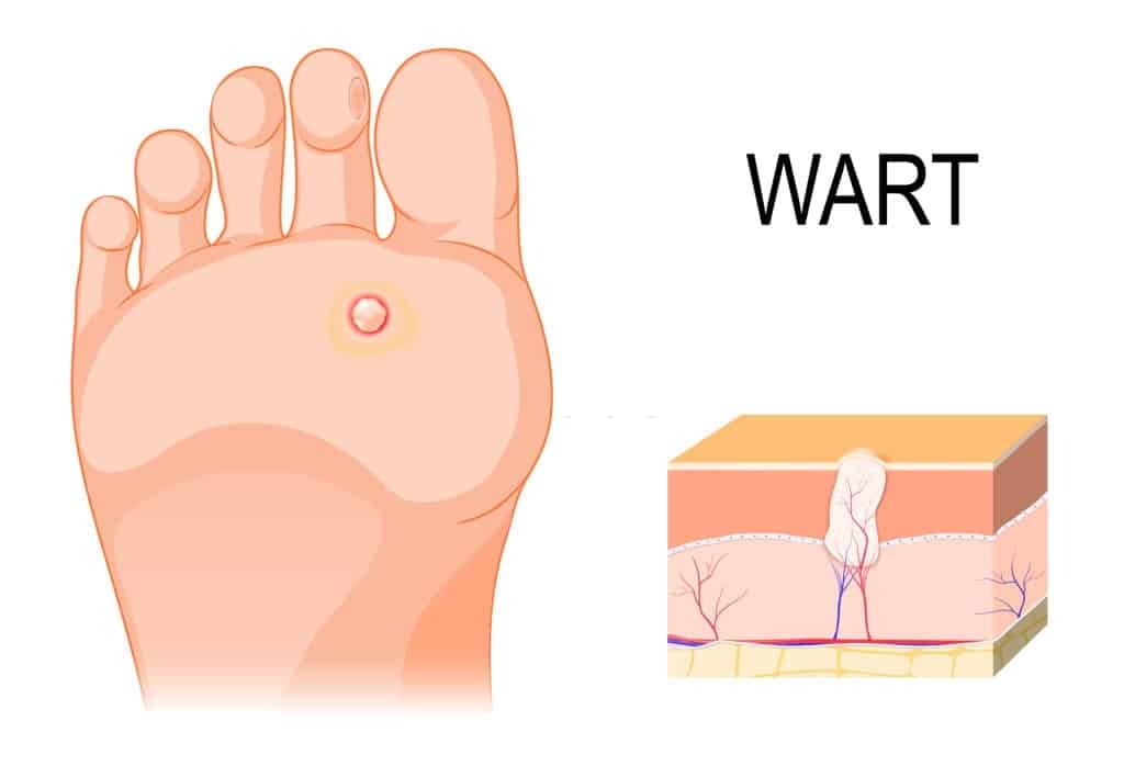 how to get rid of warts
