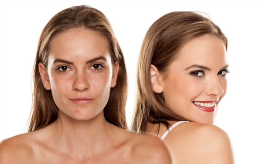 get rid of acne instantly